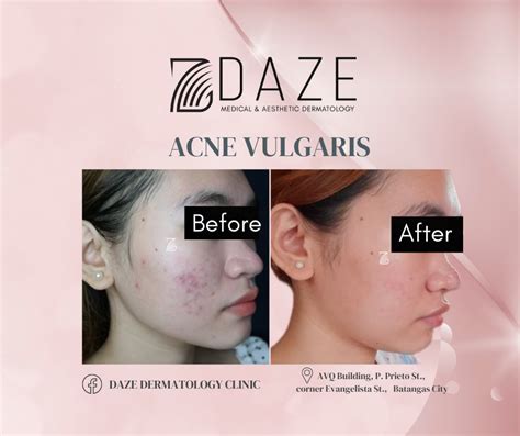 daze dermatology clinic|Acne treatment requires .